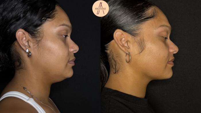 Before & After Submental Liposuction Case 385 Right Side View in San Antonio, Texas