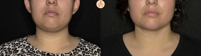 Before & After Submental Liposuction Case 386 Front View in San Antonio, Texas