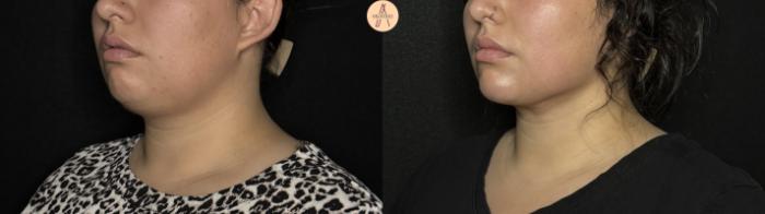 Before & After Submental Liposuction Case 386 Left Oblique View in San Antonio, Texas