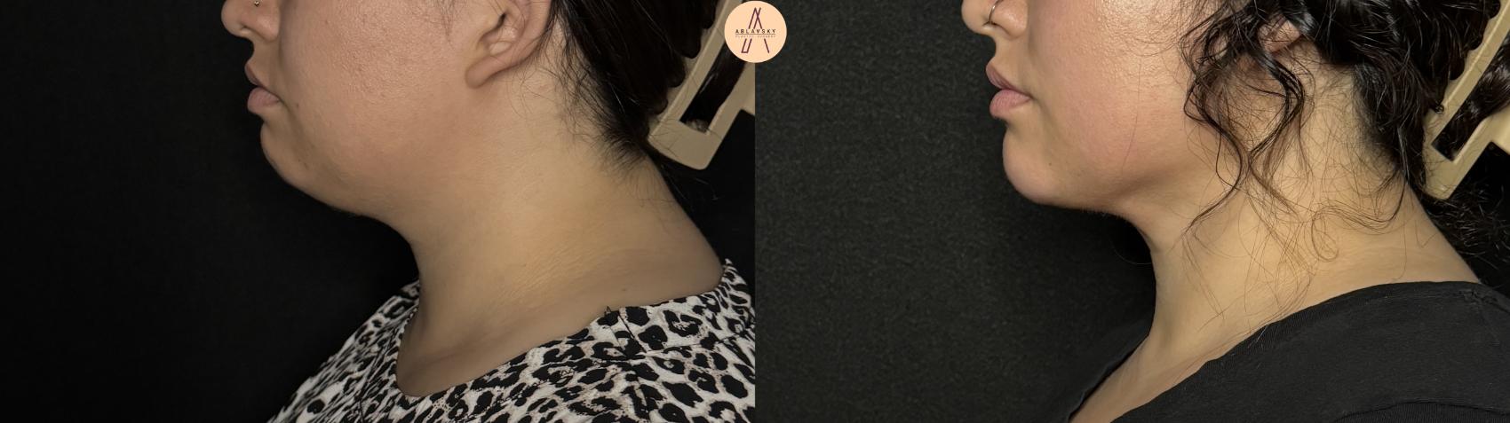 Before & After Submental Liposuction Case 386 Left Side View in San Antonio, Texas