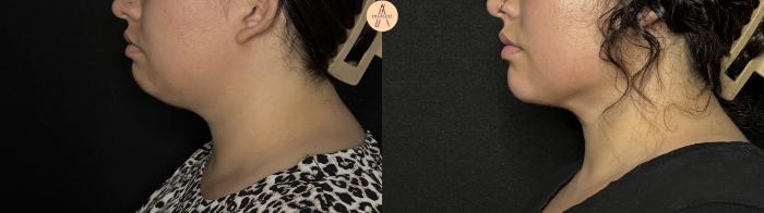 Before & After Submental Liposuction Case 386 Left Side View in San Antonio, Texas