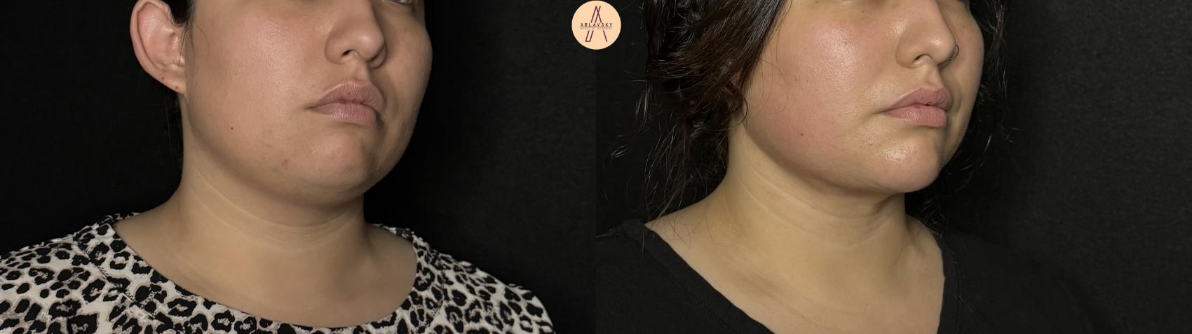 Before & After Submental Liposuction Case 386 Right Oblique View in San Antonio, Texas