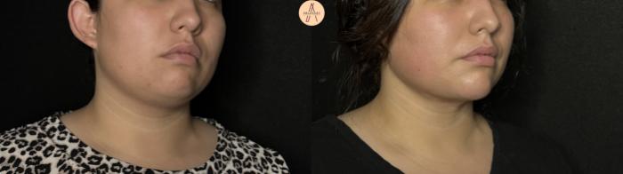 Before & After Submental Liposuction Case 386 Right Oblique View in San Antonio, Texas