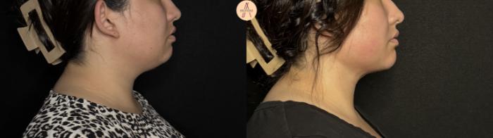 Before & After Submental Liposuction Case 386 Right Side View in San Antonio, Texas