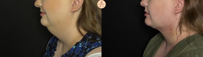 Before & After Submental Liposuction Case 389 Left Side View in San Antonio, Texas