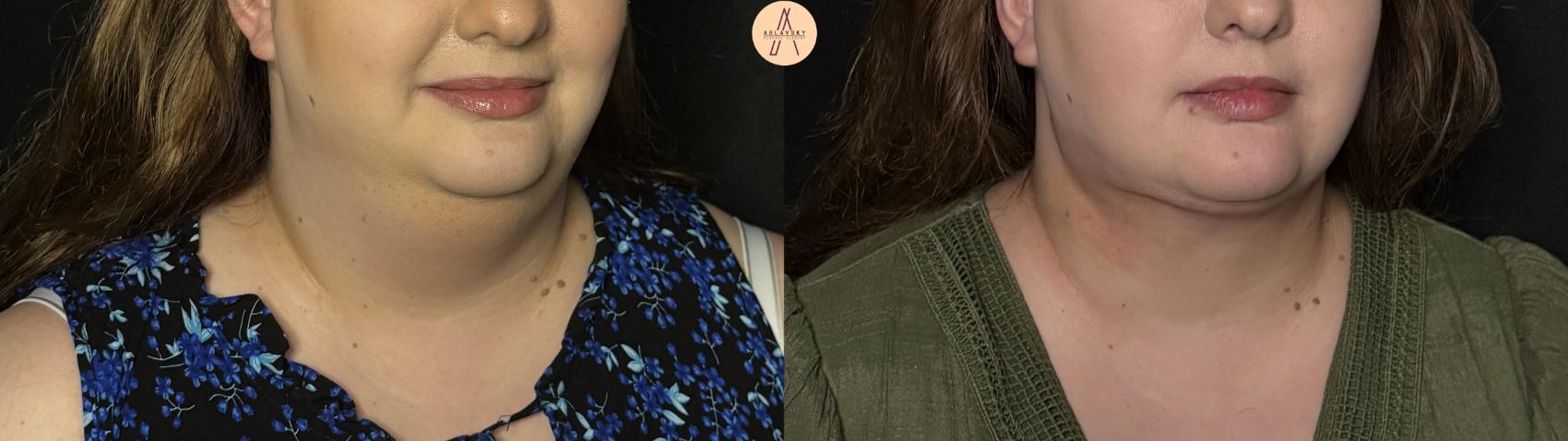 Before & After Submental Liposuction Case 389 Right Oblique View in San Antonio, Texas