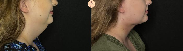 Before & After Submental Liposuction Case 389 Right Side View in San Antonio, Texas