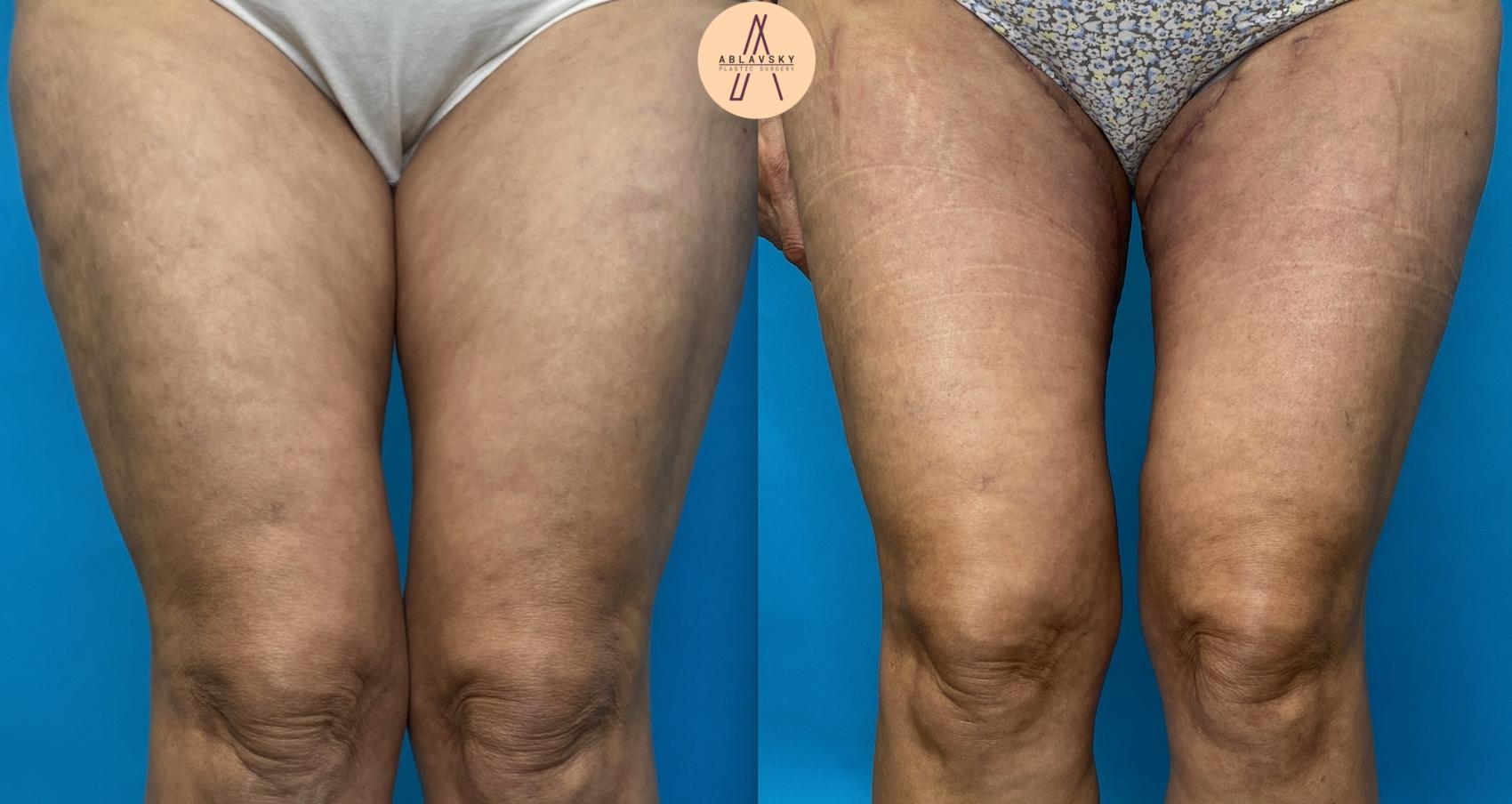 Before & After Thigh Lift Case 10 Front View in San Antonio, Texas