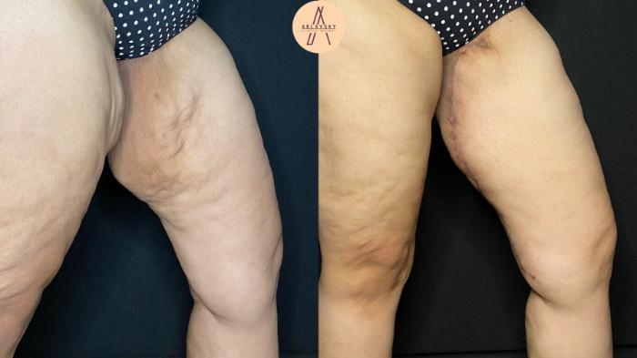 Before & After Thigh Lift Case 101 Left Oblique View in San Antonio, Texas