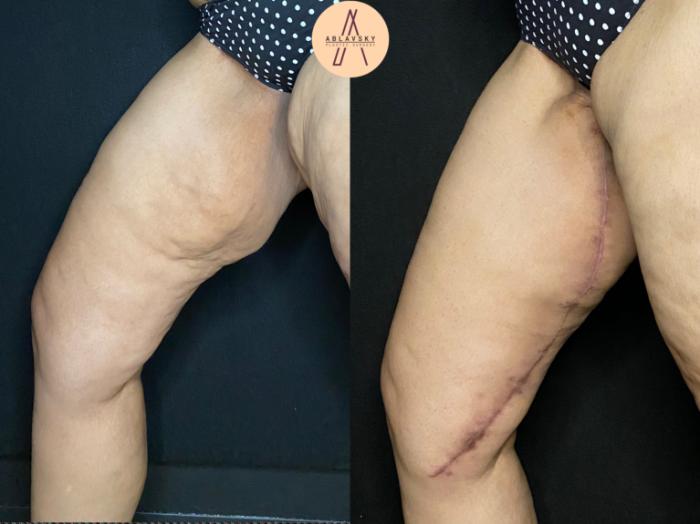 Before & After Thigh Lift Case 101 Right Oblique View in San Antonio, Texas
