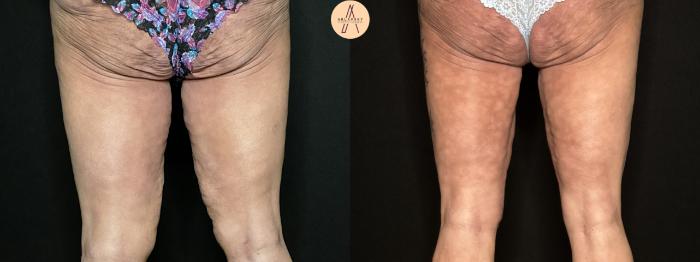 Before & After Thigh Lift Case 198 Back View in San Antonio, Texas