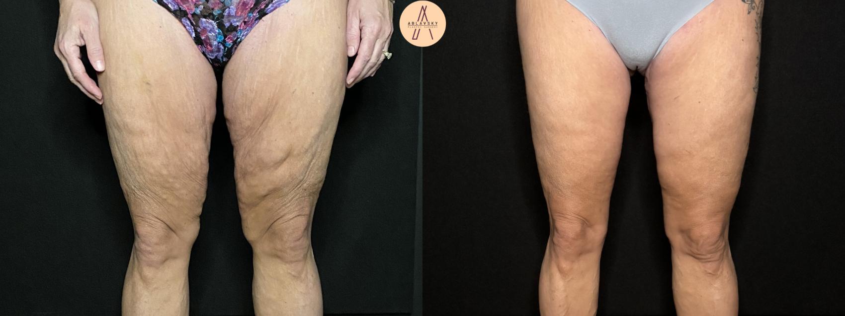 Before & After Thigh Lift Case 198 Front View in San Antonio, Texas