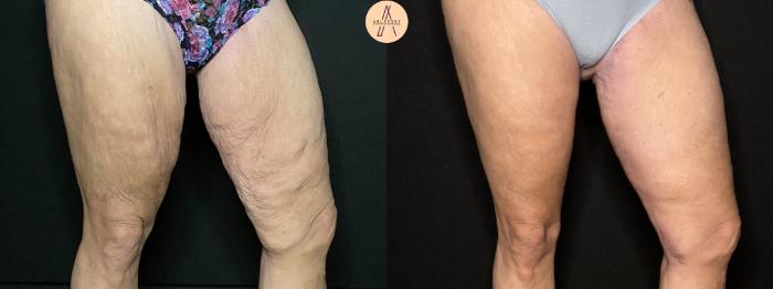 Before & After Thigh Lift Case 198 Left Side View in San Antonio, Texas