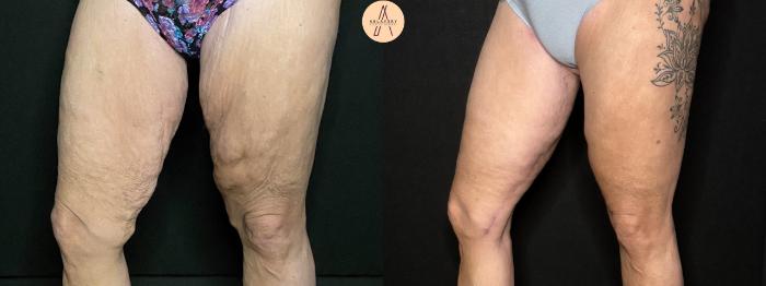 Before & After Thigh Lift Case 198 Right Side View in San Antonio, Texas