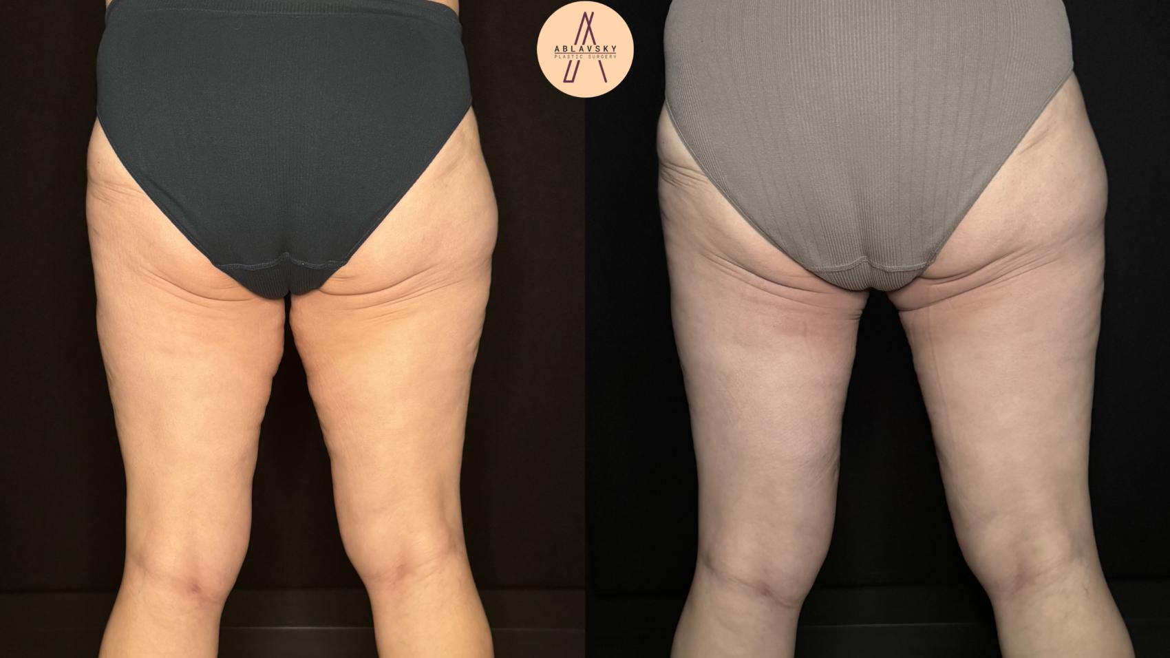 Before & After Thigh Lift Case 332 Back View in San Antonio, Texas