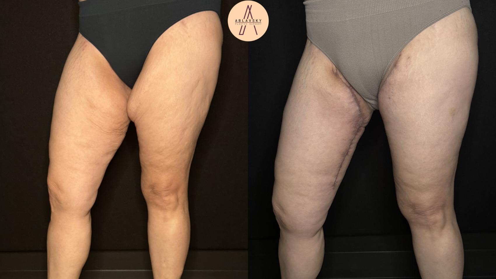 Before & After Thigh Lift Case 332 Right Side View in San Antonio, Texas