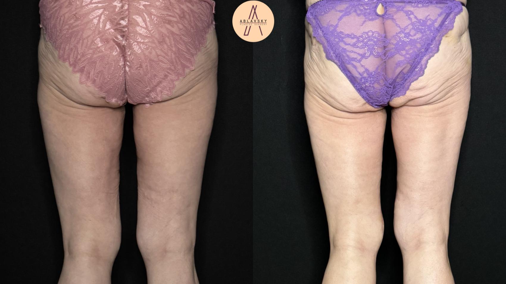 Before & After Thigh Lift Case 383 Back View in San Antonio, Texas