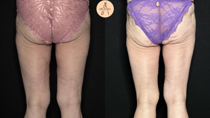 Before & After Thigh Lift Case 383 Back View in San Antonio, Texas