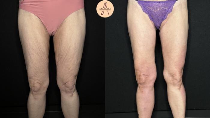 Before & After Thigh Lift Case 383 Front View in San Antonio, Texas
