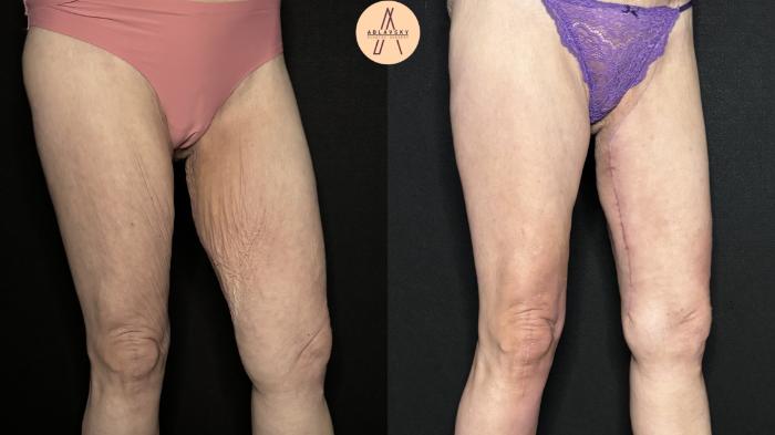 Before & After Thigh Lift Case 383 Left Side View in San Antonio, Texas
