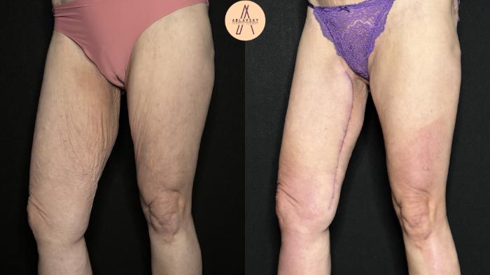 Before & After Thigh Lift Case 383 Right Side View in San Antonio, Texas