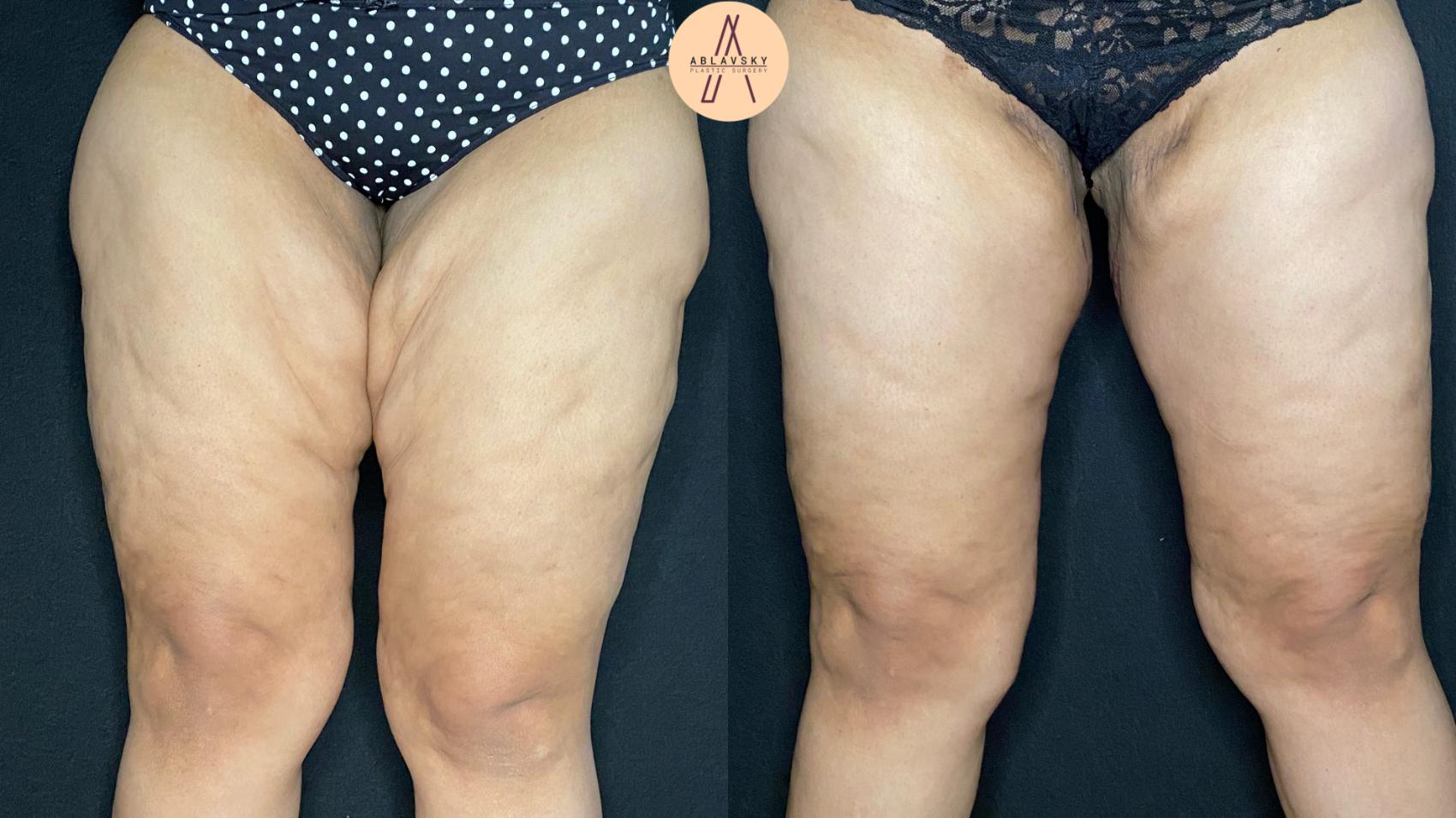 Before & After Thigh Lift Case 58 Front View in San Antonio, Texas