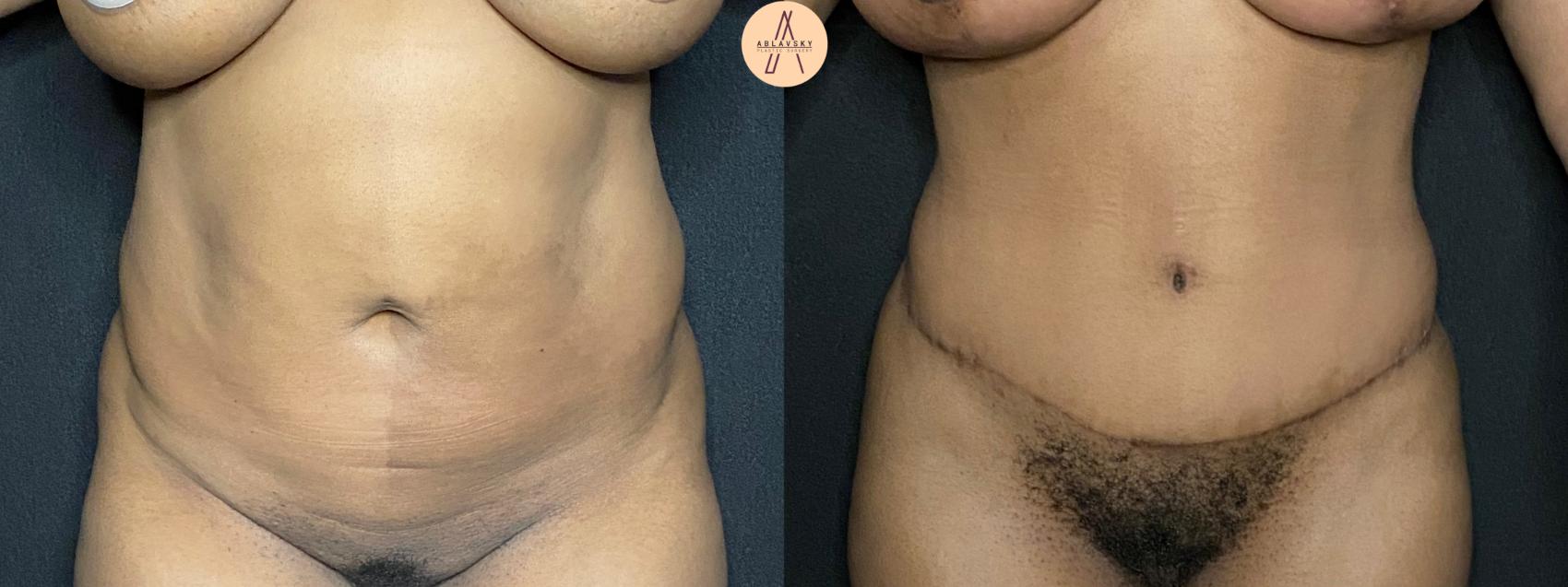 Before & After Tummy Tuck Case 103 Front View in San Antonio, Texas