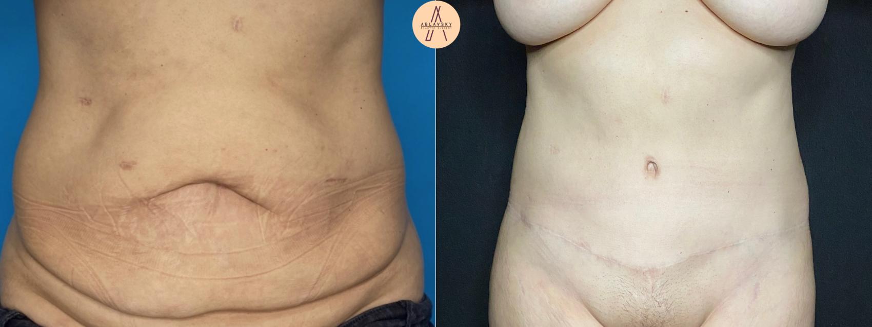 Before & After Tummy Tuck Case 11 Front View in San Antonio, Texas