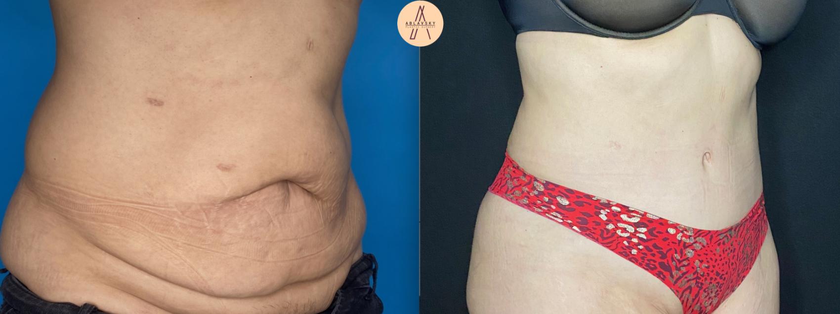 Liposuction 360 of abdomen and hips San Antonio Ablavsky Plastic Surgery