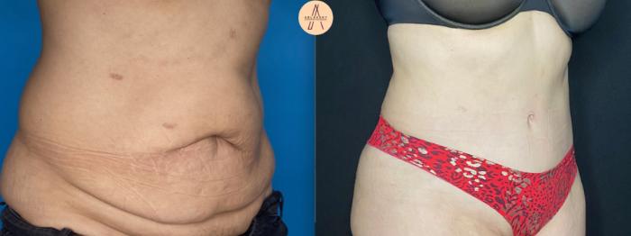 Before & After Tummy Tuck Case 11 Right Oblique View in San Antonio, Texas
