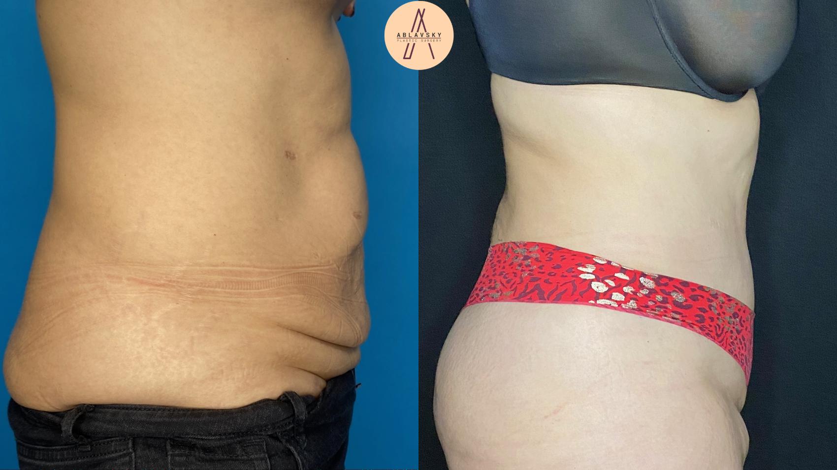 Before & After Tummy Tuck Case 11 Right Side View in San Antonio, Texas