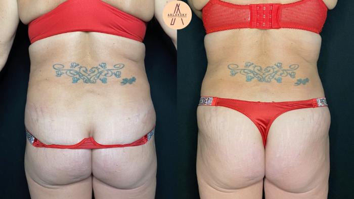 Before & After Tummy Tuck Case 111 Back View in San Antonio, Texas