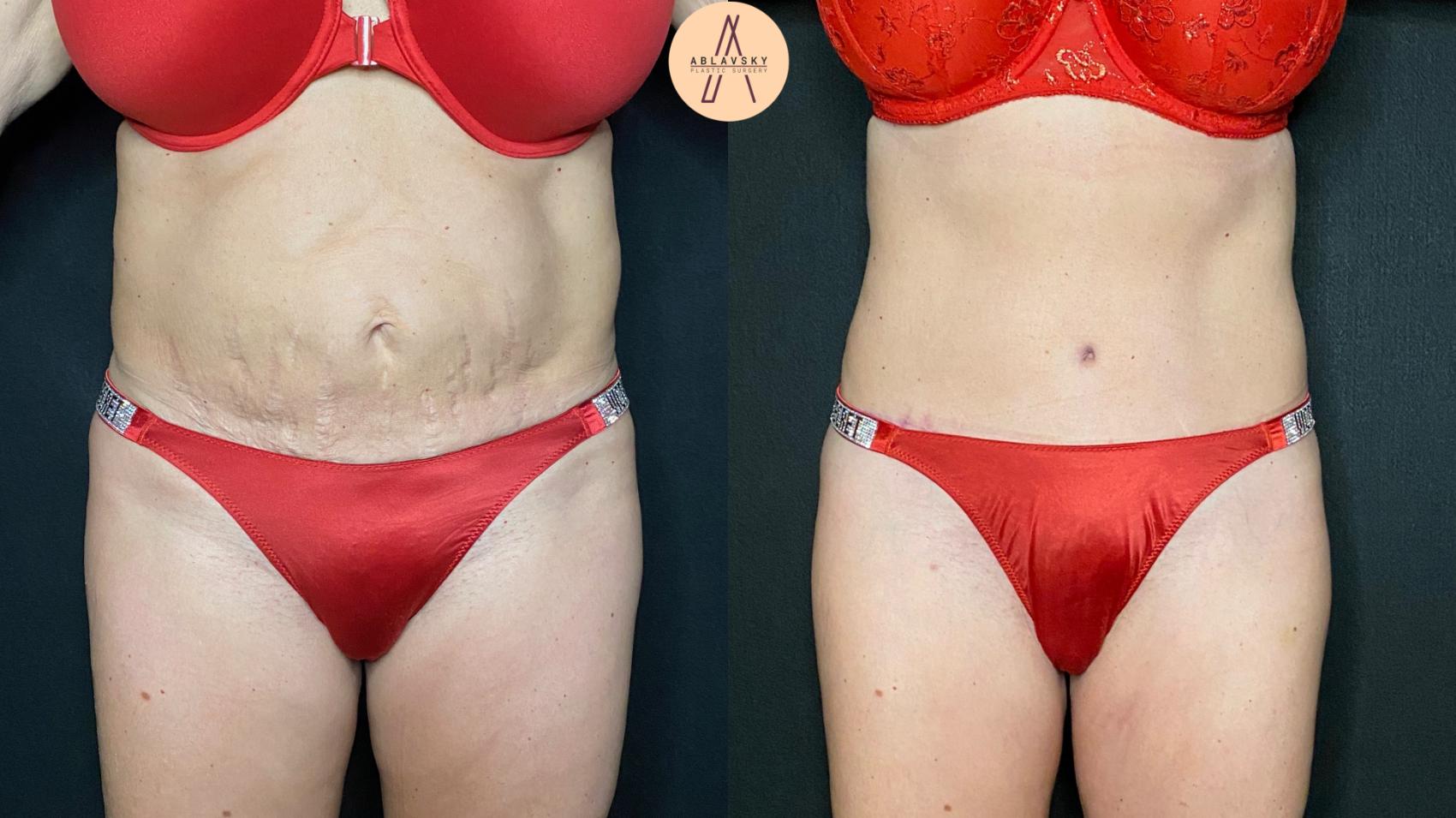 Before & After Tummy Tuck Case 111 Front View in San Antonio, Texas