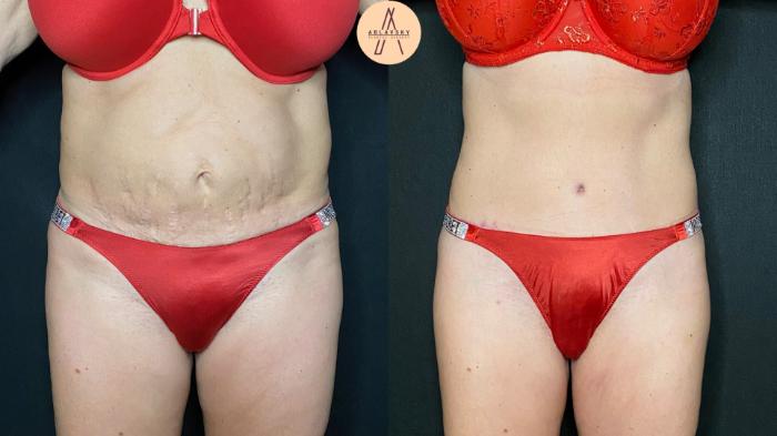 Before & After Tummy Tuck Case 111 Front View in San Antonio, Texas