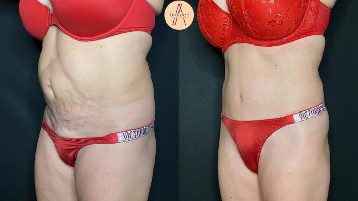 Before & After Tummy Tuck Case 111 Left Oblique View in San Antonio, Texas