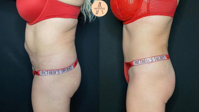 Before & After Tummy Tuck Case 111 Left Side View in San Antonio, Texas