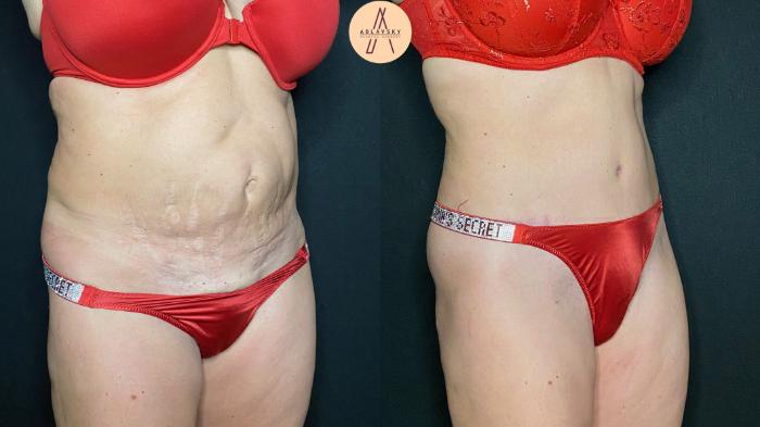 Before & After Tummy Tuck Case 111 Right Oblique View in San Antonio, Texas