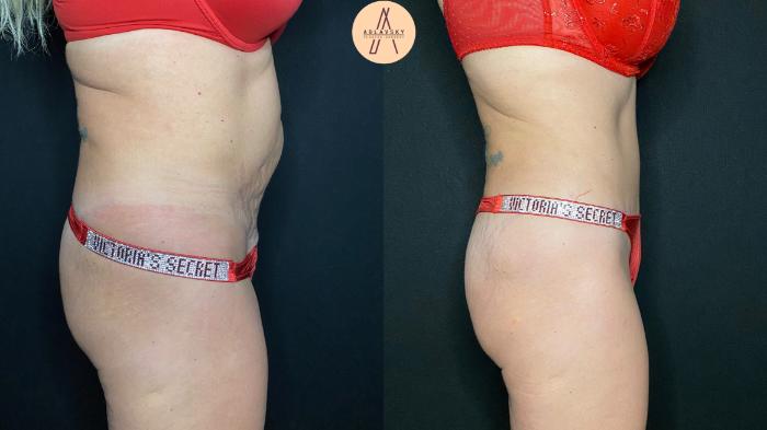 Before & After Tummy Tuck Case 111 Right Side View in San Antonio, Texas