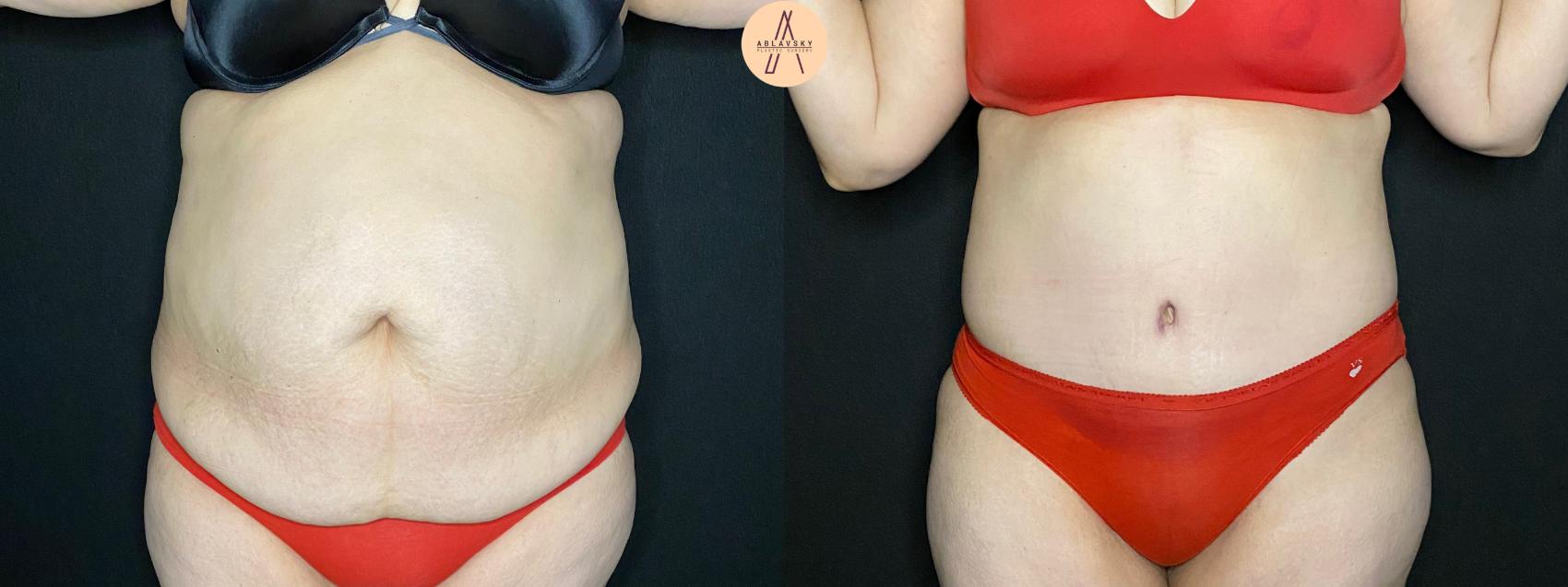 Before & After Tummy Tuck Case 116 Front View in San Antonio, Texas