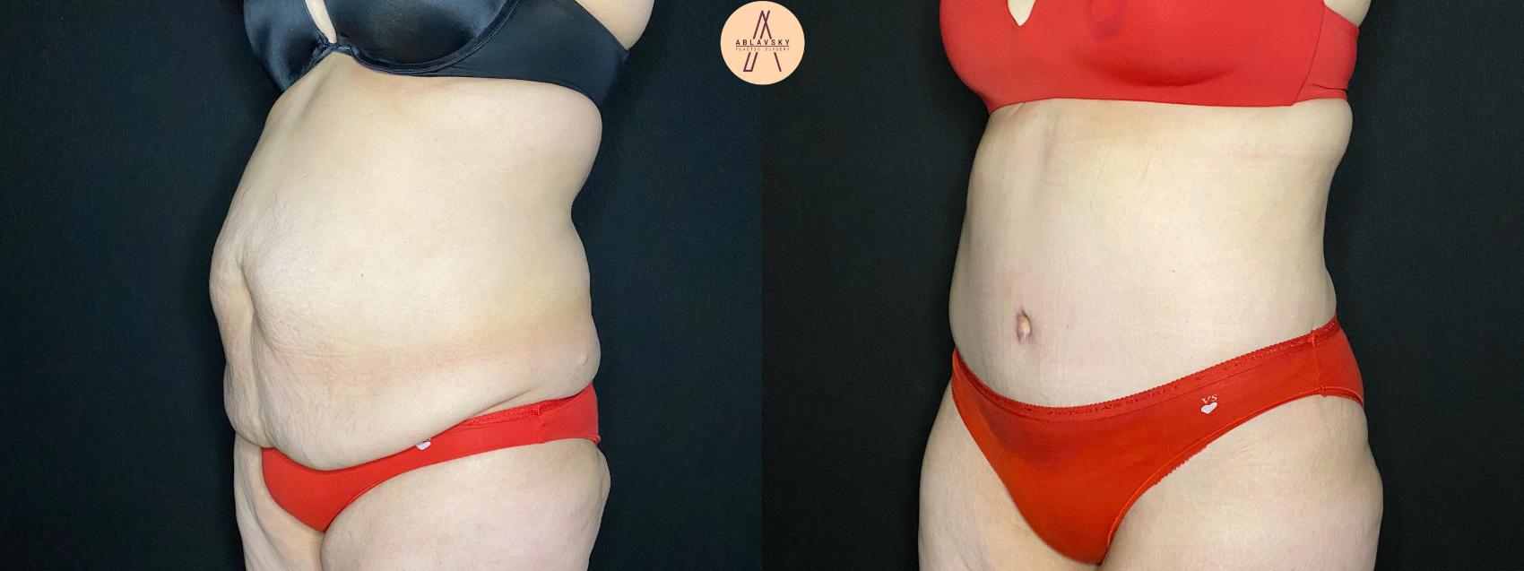 Before & After Tummy Tuck Case 116 Left Oblique View in San Antonio, Texas
