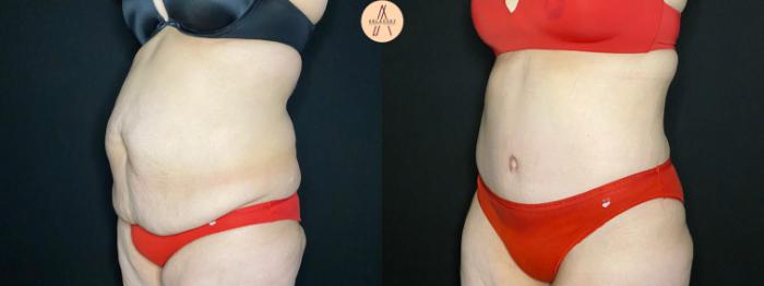 Before & After Tummy Tuck Case 116 Left Oblique View in San Antonio, Texas