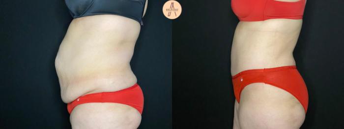 Before & After Tummy Tuck Case 116 Left Side View in San Antonio, Texas