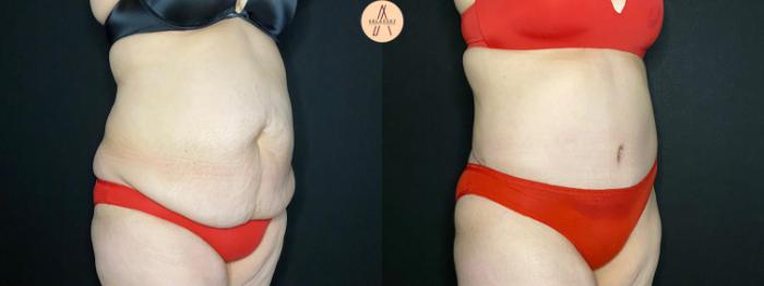 Before & After Tummy Tuck Case 116 Right Oblique View in San Antonio, Texas
