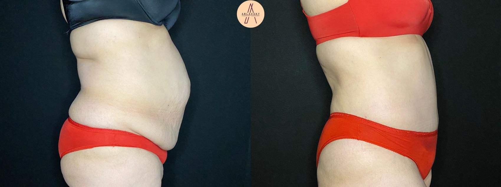 Before & After Tummy Tuck Case 116 Right Side View in San Antonio, Texas