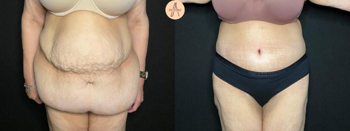 Before & After Tummy Tuck Case 117 Front View in San Antonio, Texas