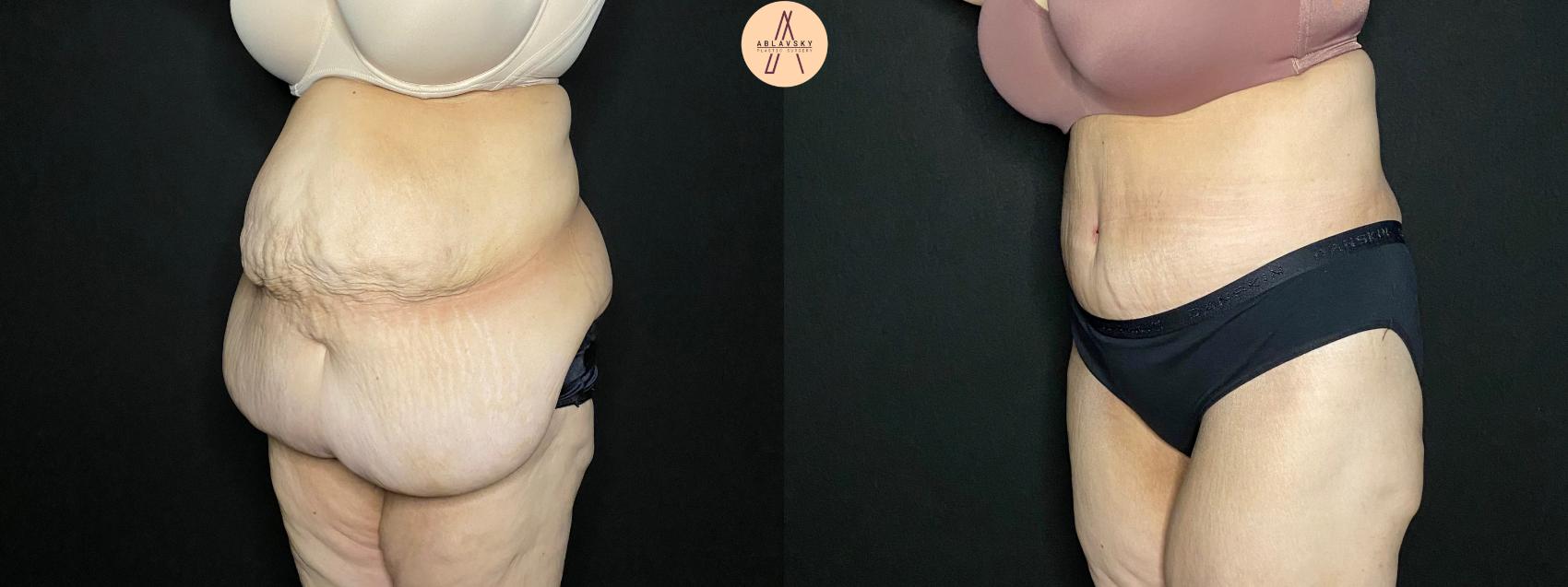 Before & After Tummy Tuck Case 117 Left Oblique View in San Antonio, Texas