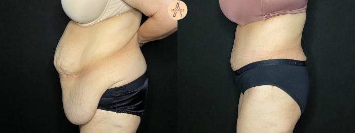 Before & After Tummy Tuck Case 117 Left Side View in San Antonio, Texas