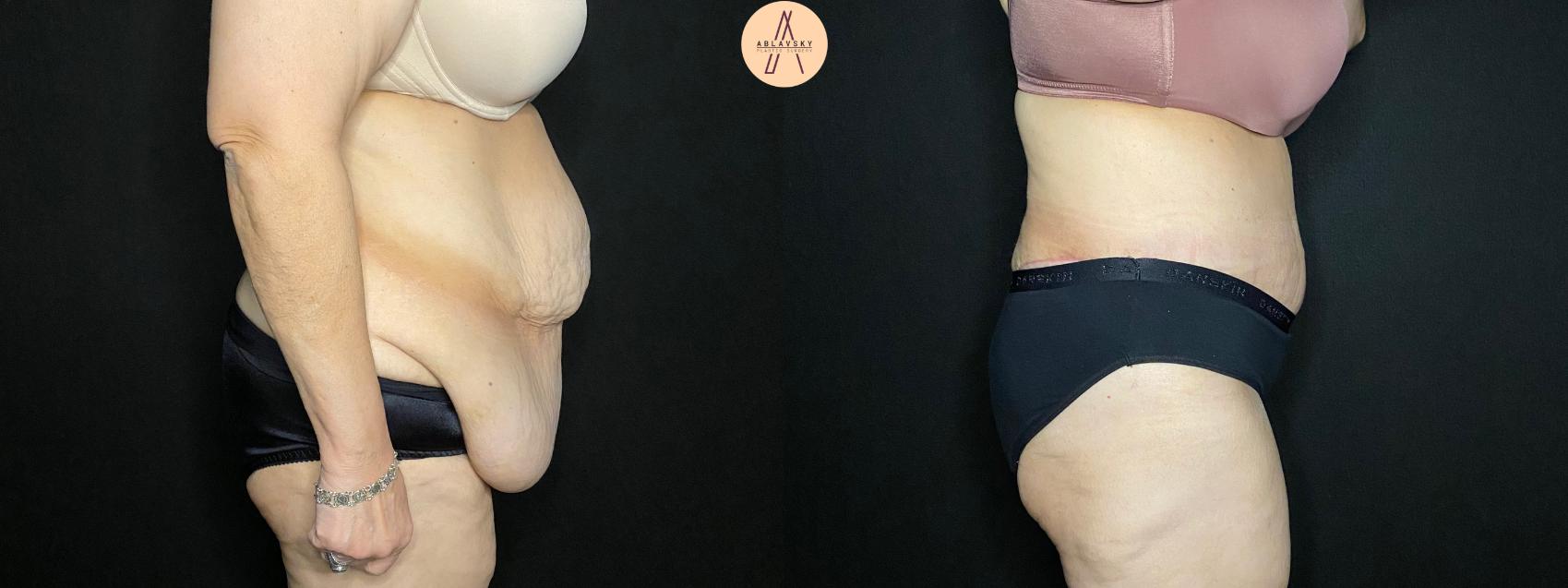 Before & After Tummy Tuck Case 117 Right Side View in San Antonio, Texas