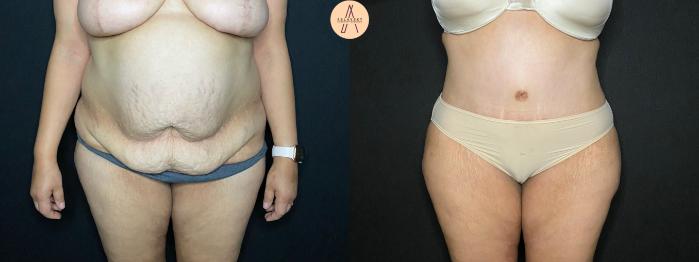 Before & After Tummy Tuck Case 118 Front View in San Antonio, Texas