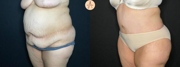 Before & After Tummy Tuck Case 118 Left Oblique View in San Antonio, Texas